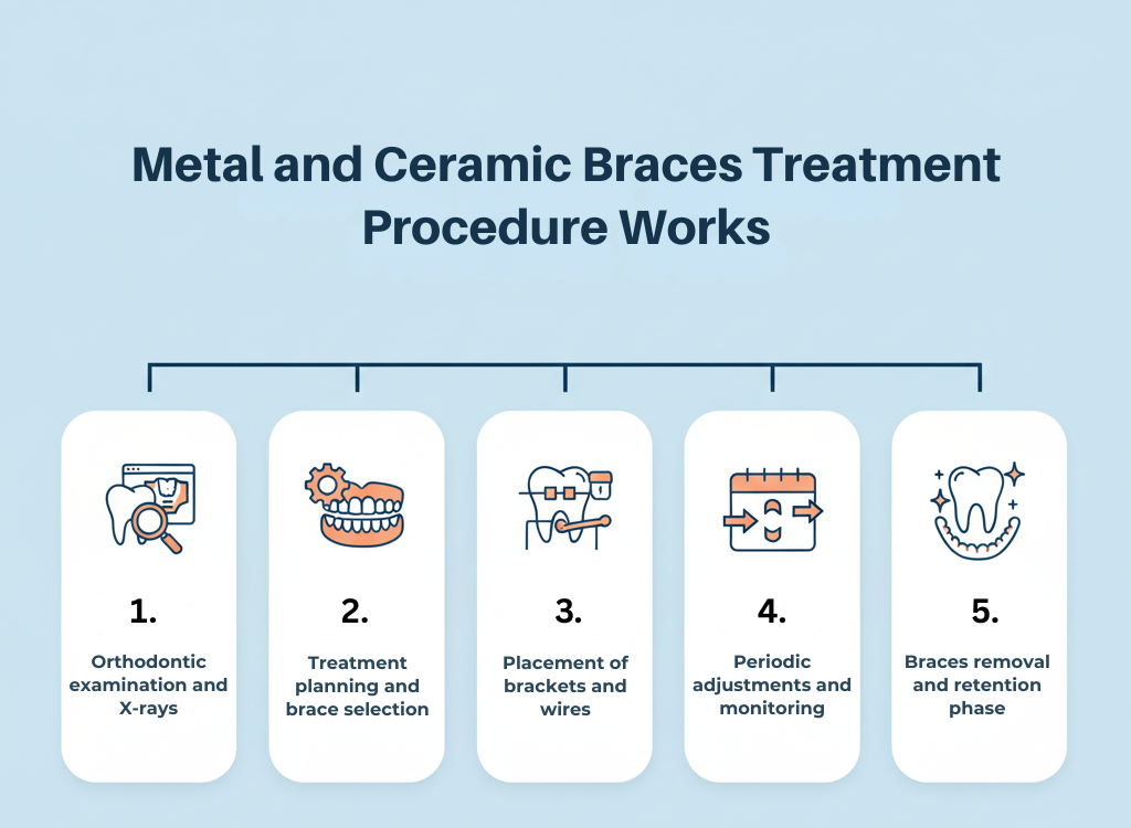 Metal and ceramic braces