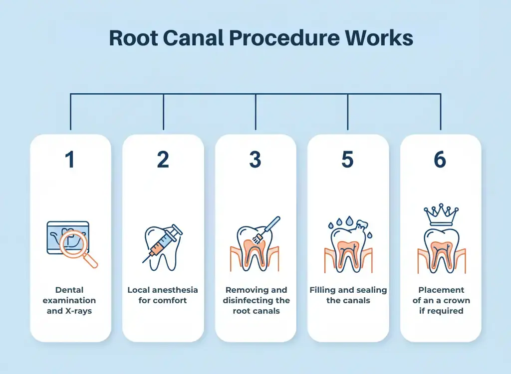 Root canal Procedure
