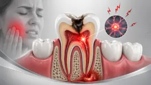 Cross-section of a tooth showing deep cavity, inflamed nerve, and infection causing severe tooth pain.